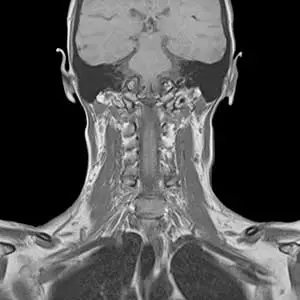 MRI image of the neck